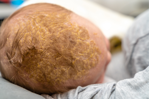 how long does cradle cap last