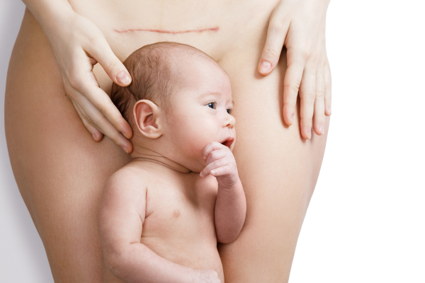 how to prepare for a c section
