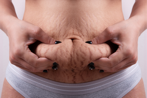 how to tighten skin after pregnancy without surgery