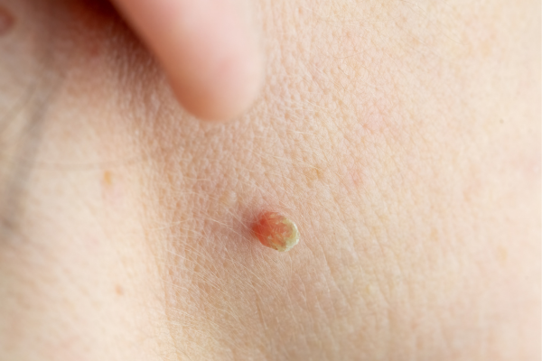 skin tags while pregnant